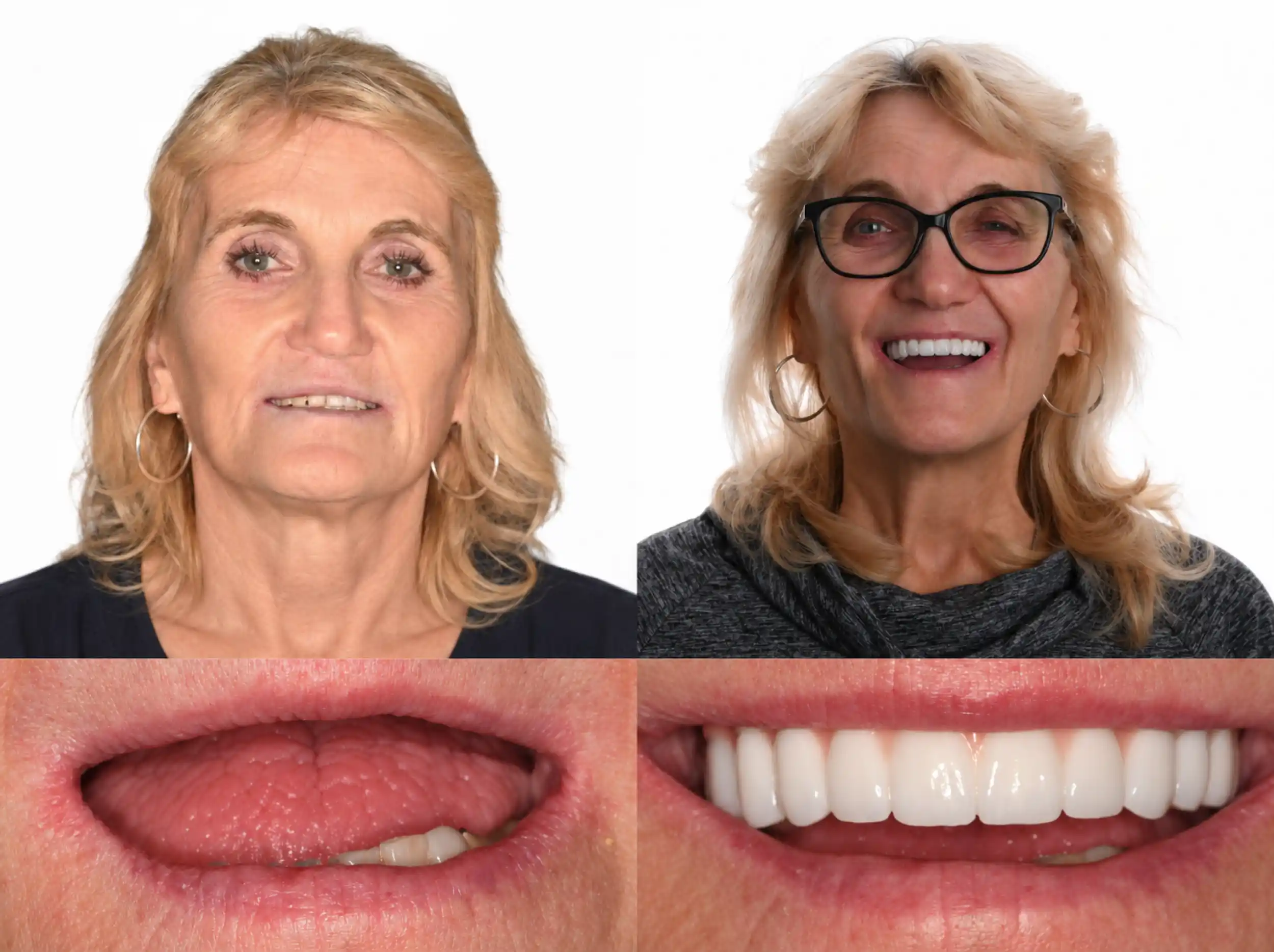 Before and after smile transformation of a woman with blonde hair: missing upper teeth before, a full, natural-looking white smile after