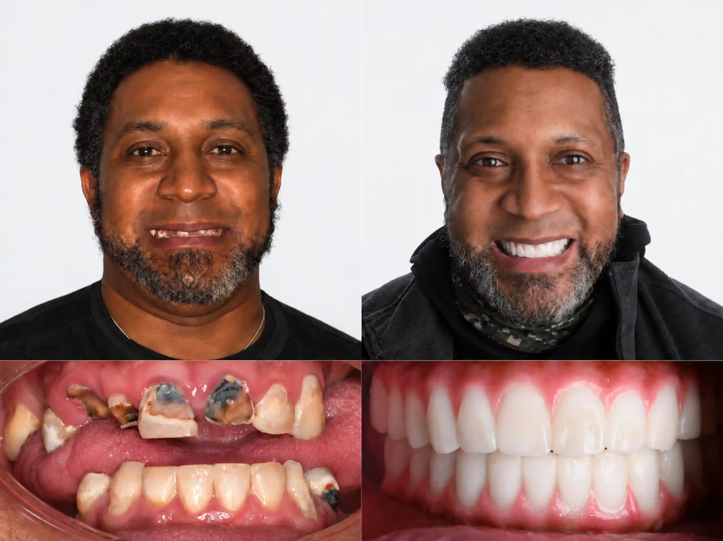 Before and after smile transformation of a bearded man: broken, decayed and missing front teeth before, a full, bright white smile after