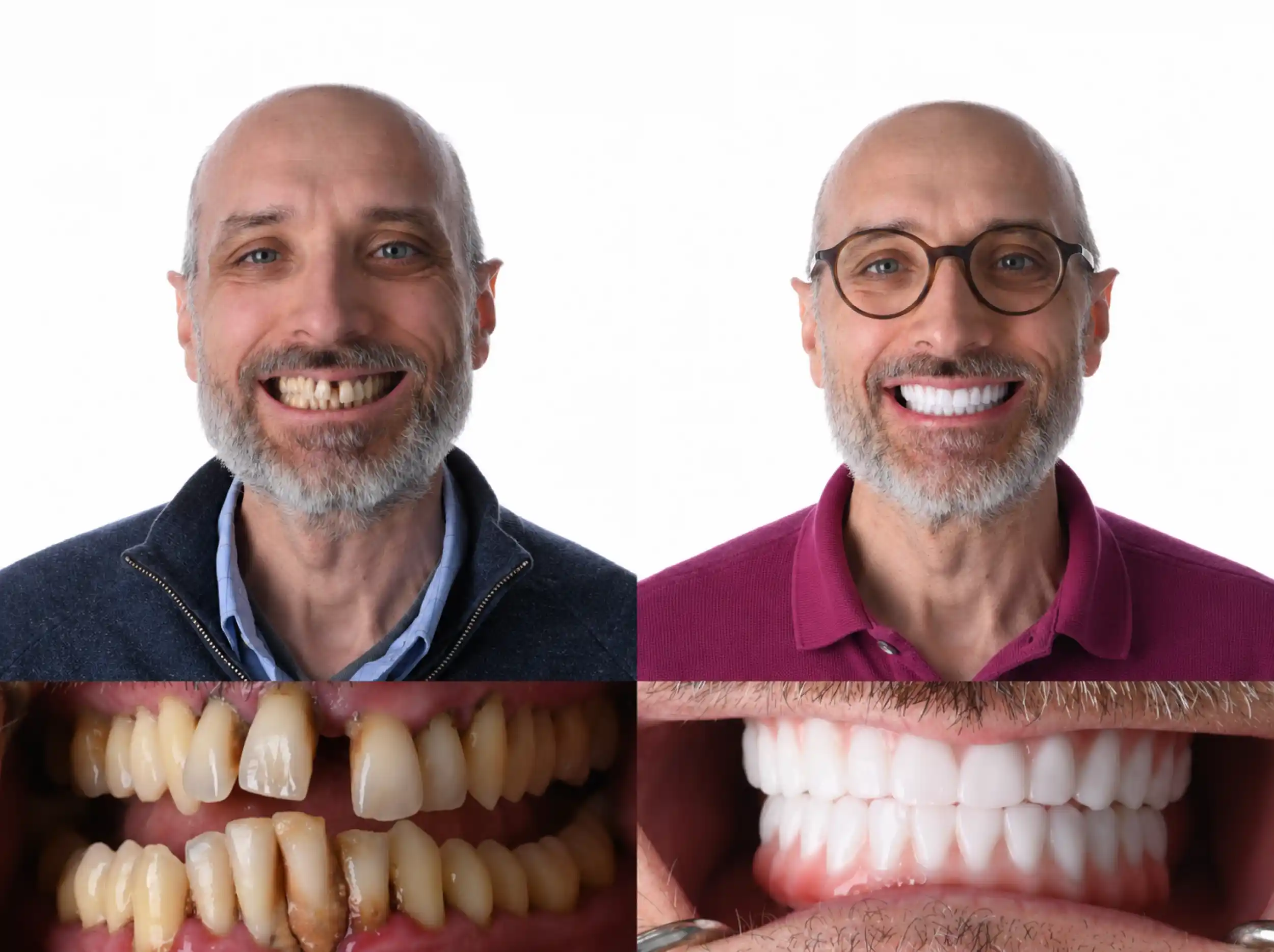 Before and after smile makeover of a bearded man: worn, crooked, gapped teeth before, straight, bright white teeth after