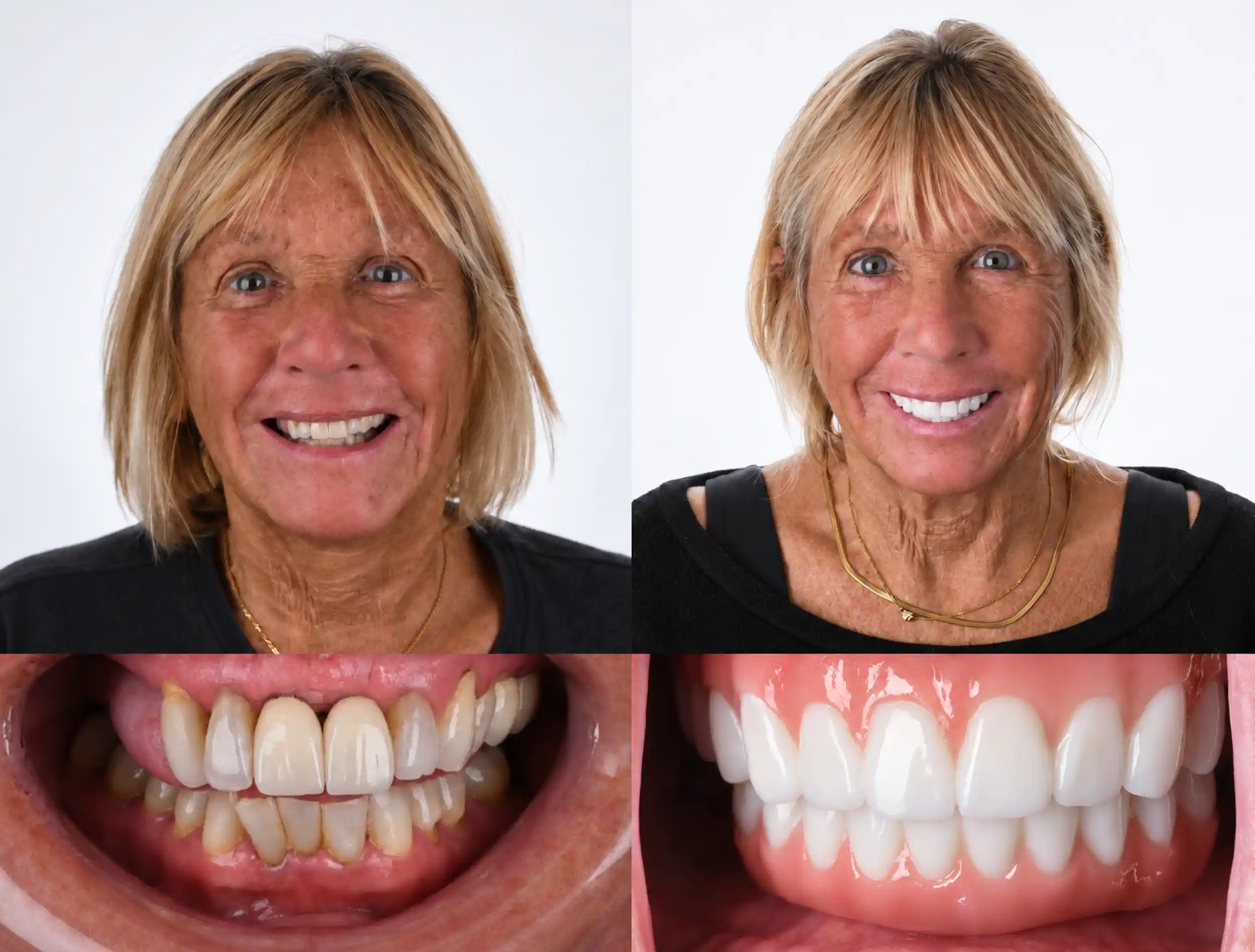 Before and after cosmetic smile makeover of a woman with blonde hair: uneven, worn teeth before, bright, uniform white veneers after