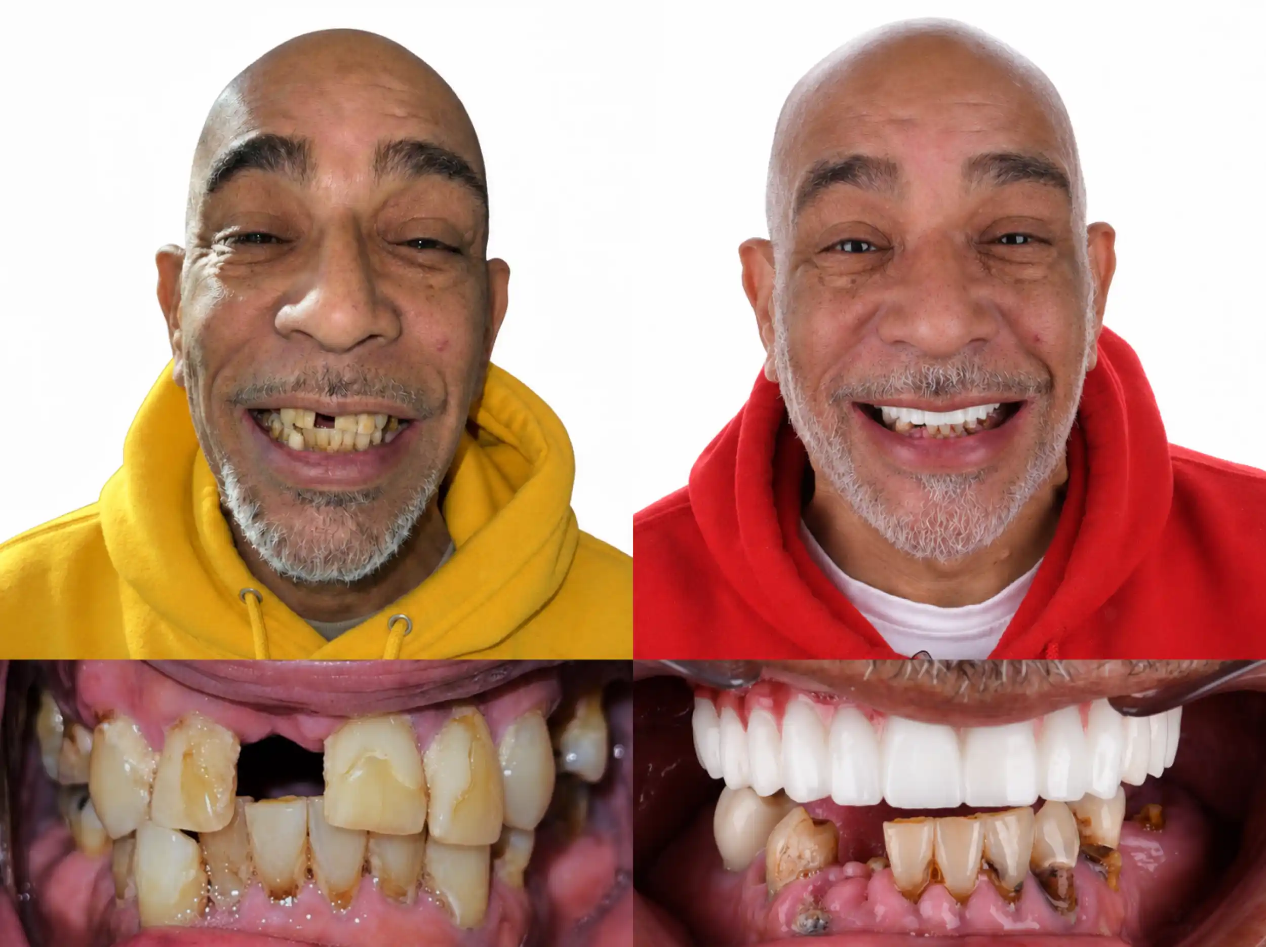 Before and after smile restoration of a man with a gray beard: missing front tooth and worn teeth before, a full, bright upper smile after