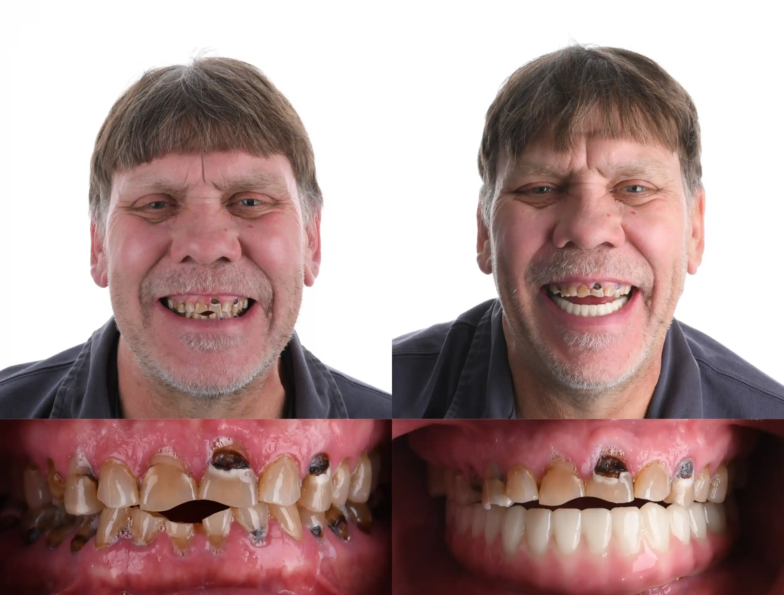Before and after dental treatment of a man with brown hair: broken, decayed teeth before, restored lower teeth and an improved smile after