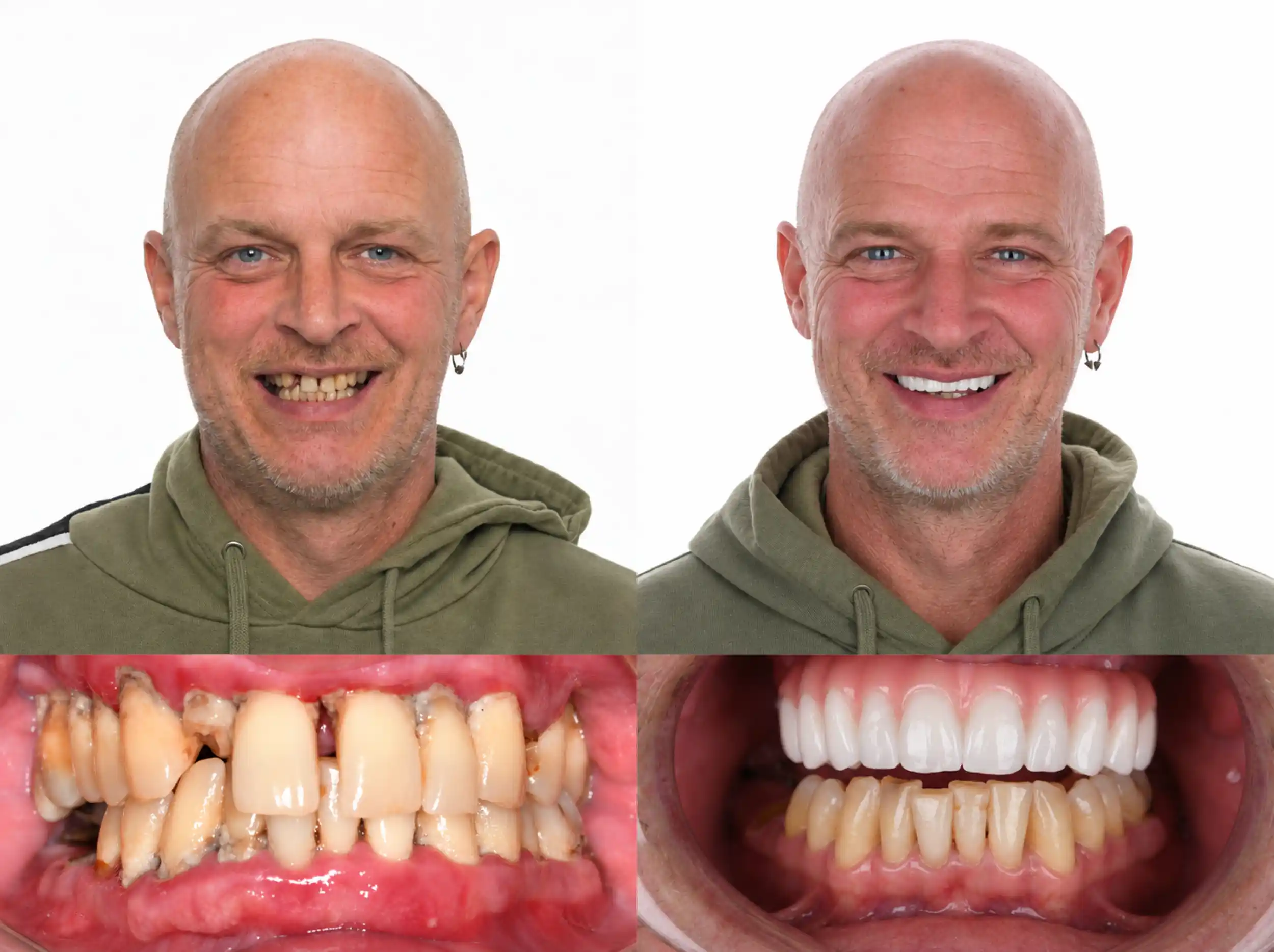 Before and after smile makeover of a man in a green hoodie: decayed, broken and discolored teeth before, a clean, even white smile after
