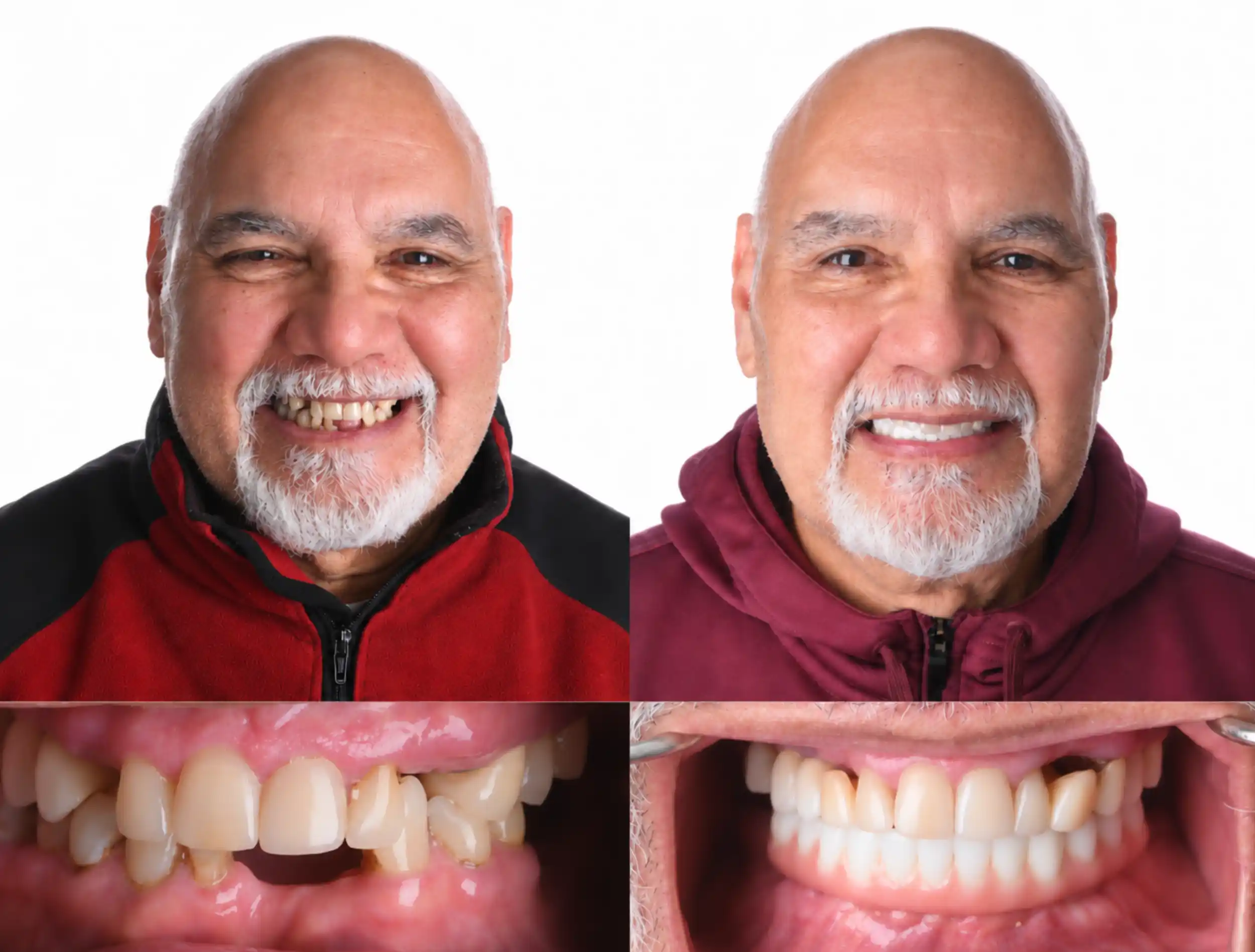 Before and after smile makeover of an older man with a white beard: worn, uneven, discolored teeth before, a straight, bright white smile after