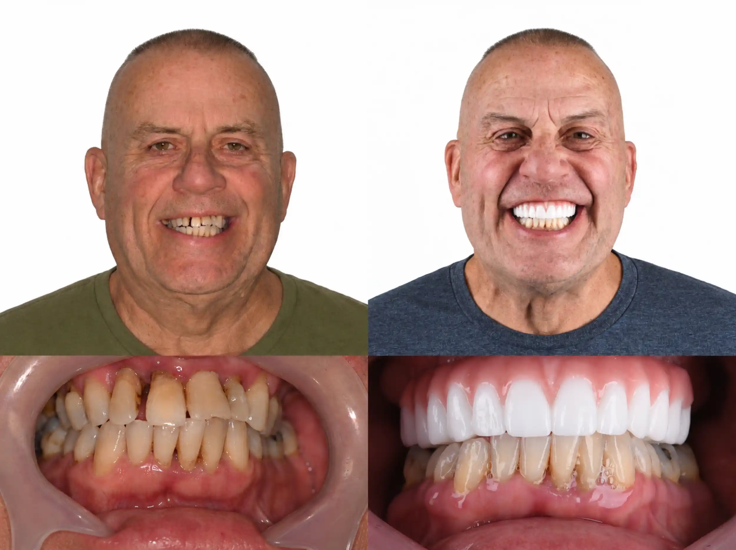 Before and after smile restoration of an older man: worn, discolored, uneven teeth before, a bright, even upper smile after