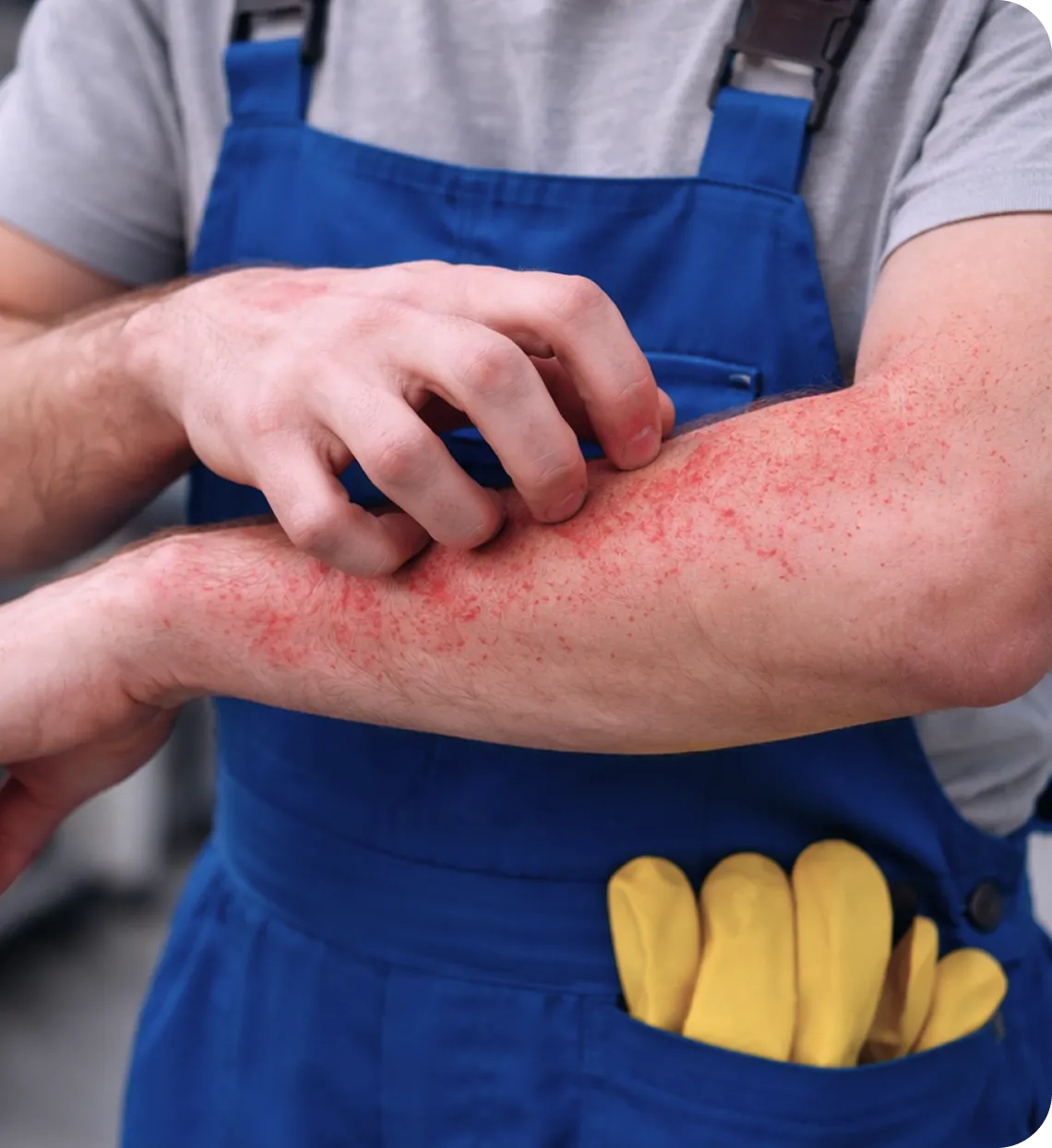 Worker in blue overalls scratching red, irritated rash on forearm in industrial setting.