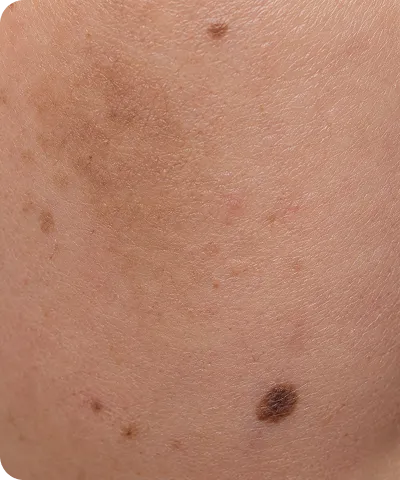 Close-up of human skin with several moles and pigmented spots on a light brown background.