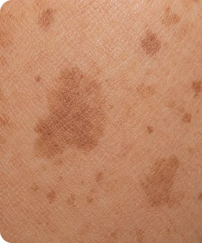 Close-up of skin showing multiple irregularly shaped brown age spots or freckles.