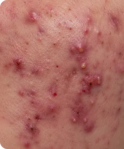 Close-up of skin with inflamed acne, showing red pimples, whiteheads, and pustules.