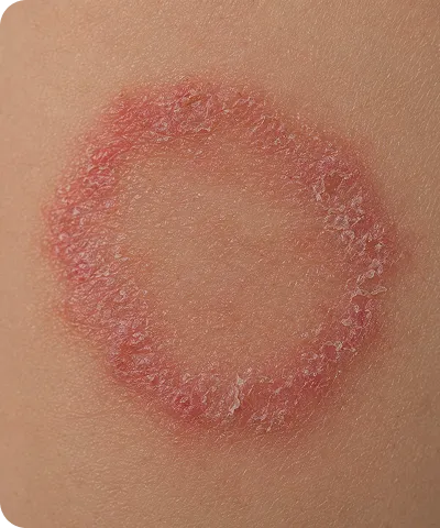 Close-up of a circular red, flaky, and irritated skin patch on human skin.