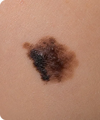 Close-up of an irregular, dark brown and black mole on light skin.