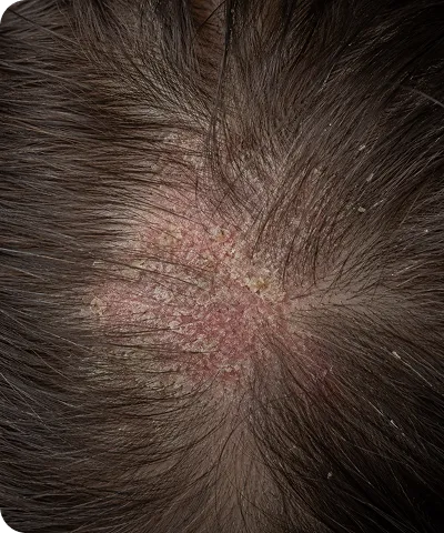 Close-up of a scalp with dry, flaky skin and redness indicating dandruff or psoriasis.
