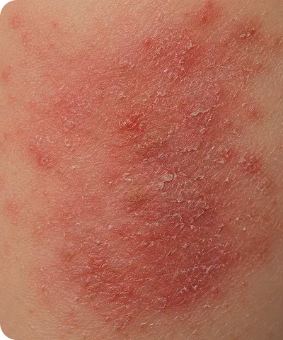 Close-up of red, dry, and flaky skin with patches of irritation and inflammation.