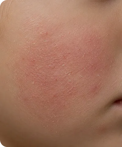 Close-up of a cheek with red, dry, and flaky irritated skin patches.