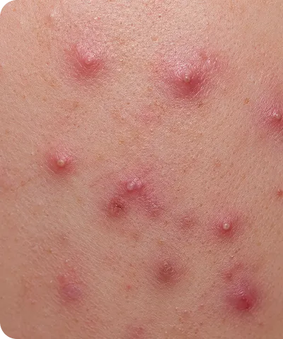 Close-up of skin with multiple inflamed red pimples, some with whiteheads, indicating acne.