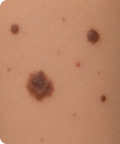 Close-up of human skin showing various moles and a small raised pink bump.