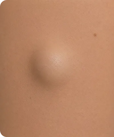 Close-up of skin with a visible raised lump or nodule and a nearby small mole.