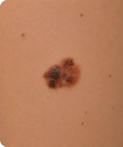 Close-up of an irregular, darkly pigmented skin mole with uneven borders on light skin.