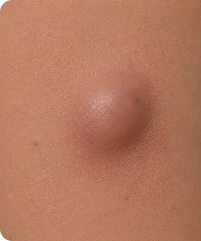 Close-up of a round, raised, smooth bump on skin resembling a cyst or lipoma.