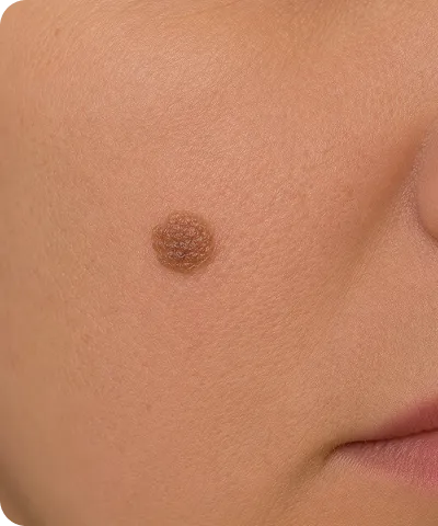 Close-up of a person’s cheek showing a raised, textured brown mole near the mouth.