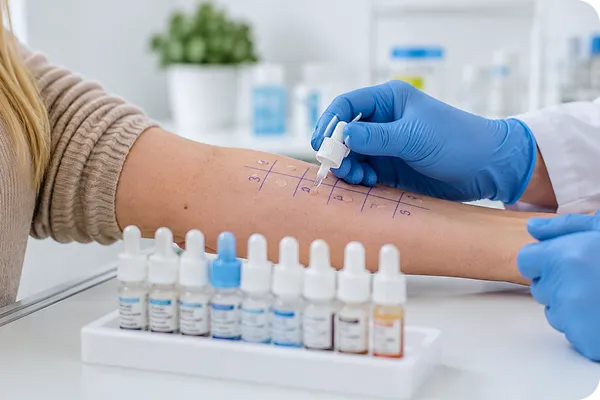 Medical worker in blue gloves applies allergen drops on marked back of a patient's arm for allergy test.