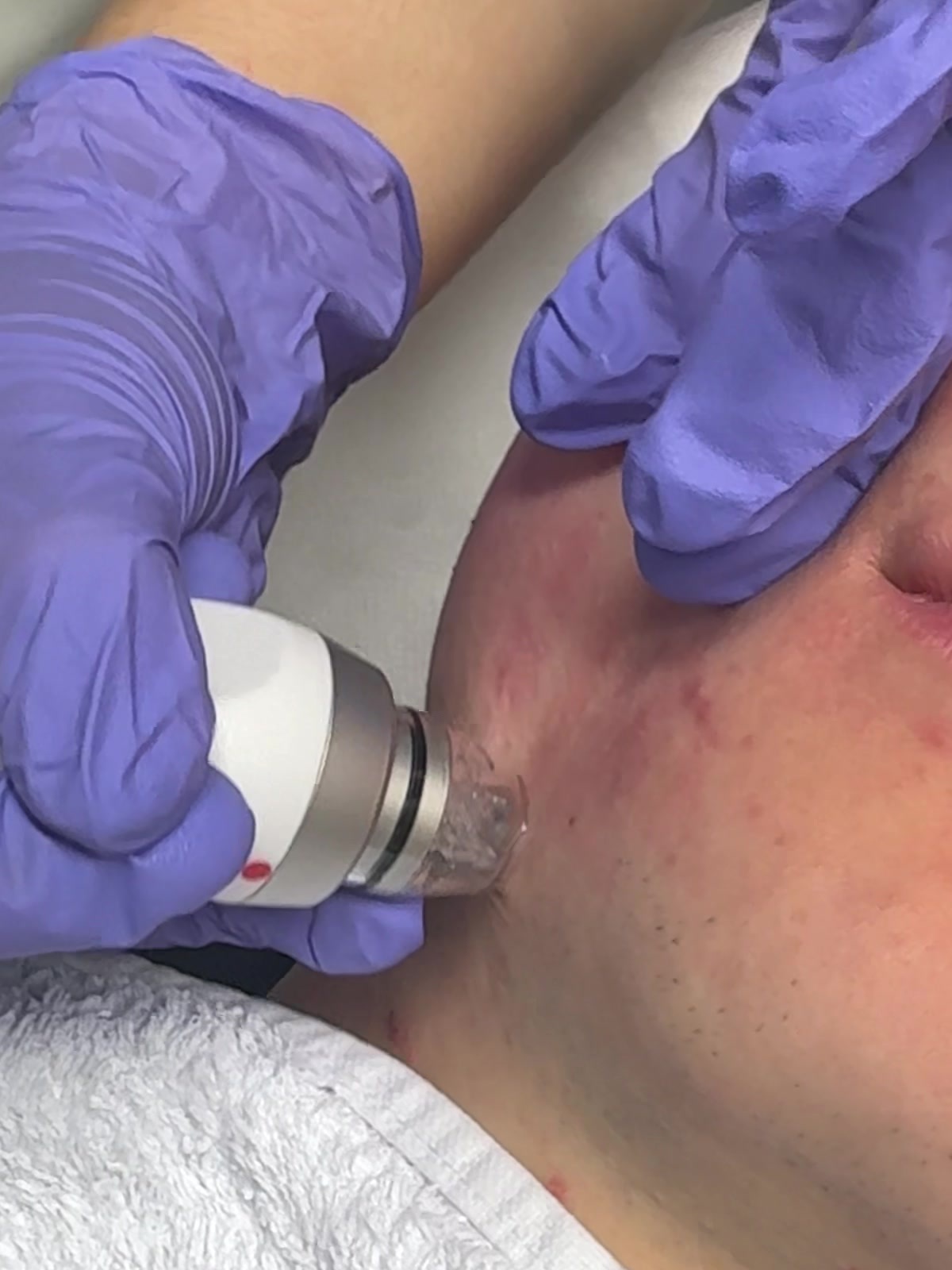 Glacē™ Gerät und Hydrodermabrasion-Technologie.