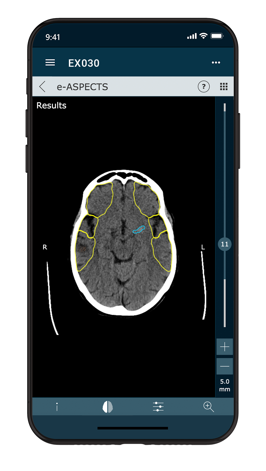 e-ASPECTS V 10.0 Mobile LVO