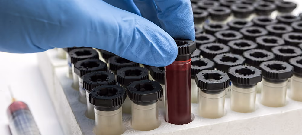 Blood sample prepared for live blood cell analysis