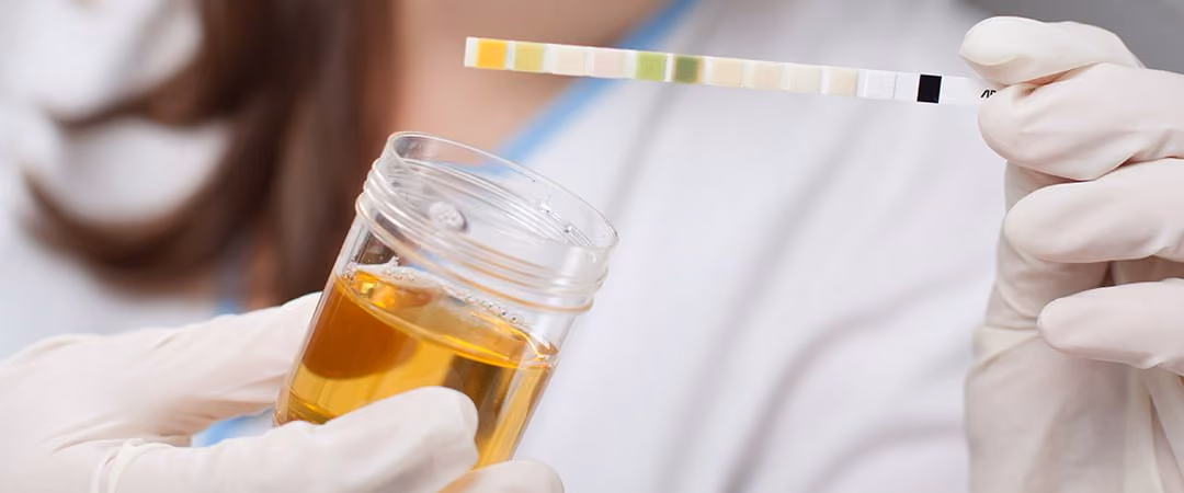 Gloved hands hold a urine sample cup and a urine test strip with color indicators.