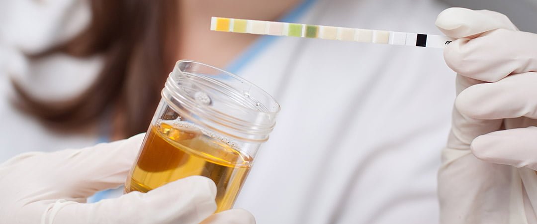 Gloved hands hold a urine sample cup and a urine test strip with color indicators.