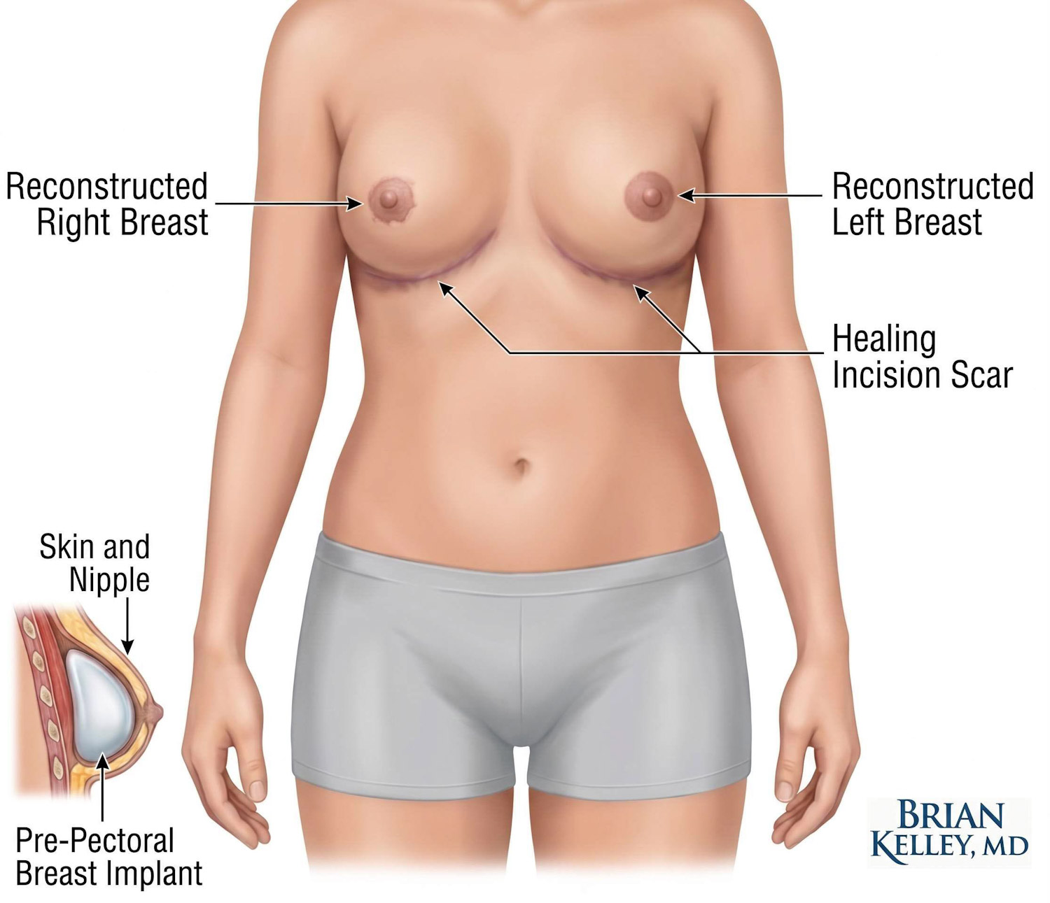Medical illustration of direct-to-implant nipple sparing breast reconstruction