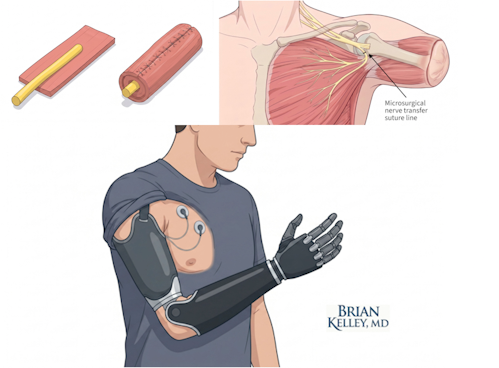 Medical illustration demonstration advanced nerve reinnervation techniques and myoelectric prosthesis in patient with upper arm amputation