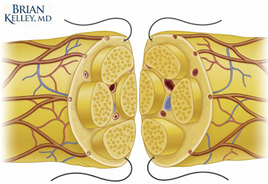 Two cut ends of a nerve show microscopic anatomy of the nerve endings and suture placement for repair