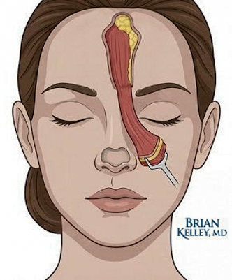 Medical illustration for a forehead flap nasal reconstruction
