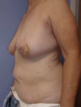 Preoperative breast photo