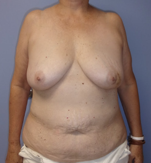 Preoperative breast photo