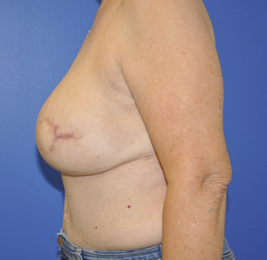 Post-operative breast photo after left skin-sparing mastectomy and DIEP flap without radiation