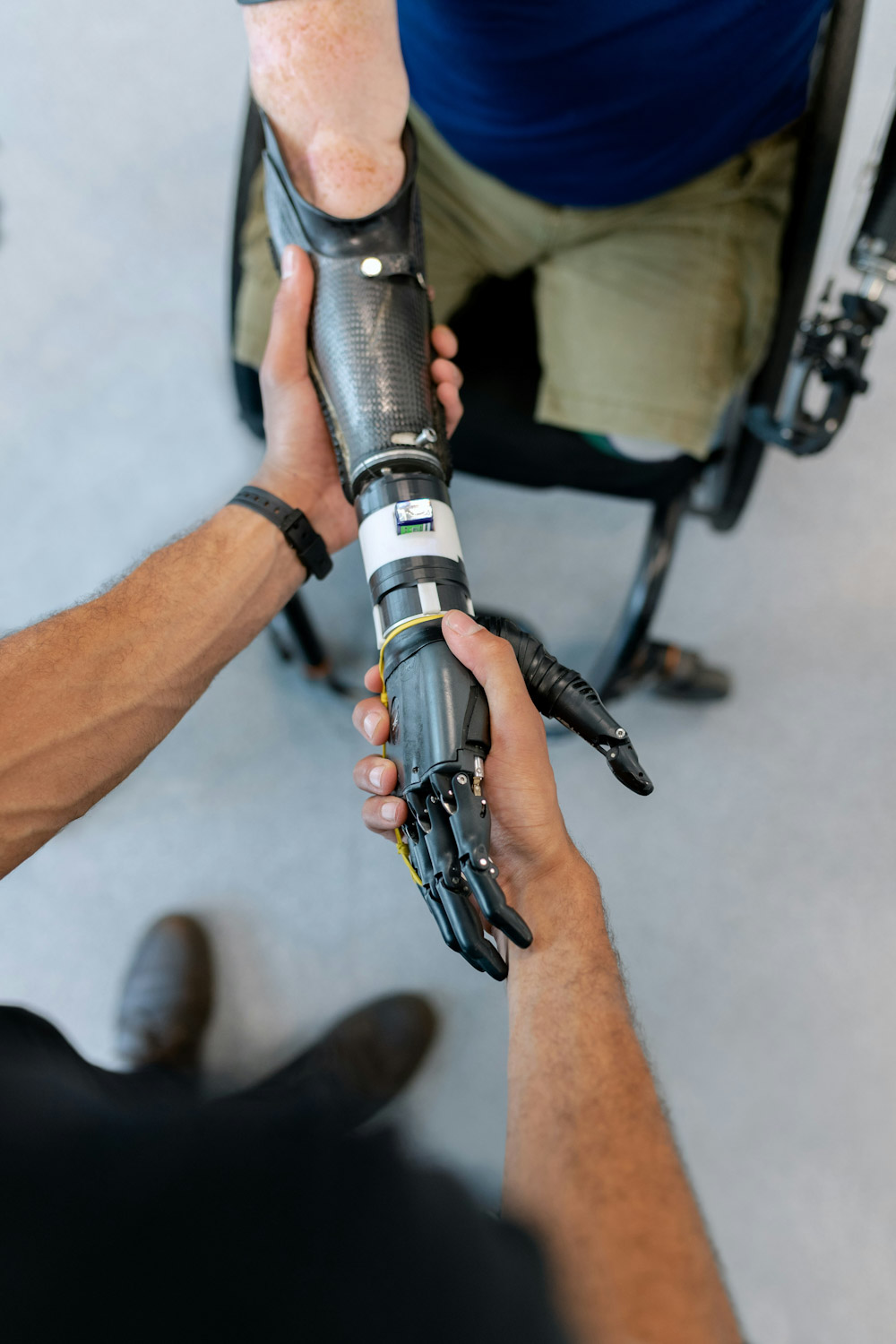A man with a right upper extremity amputation shakes hands with a myoelectric prosthesis