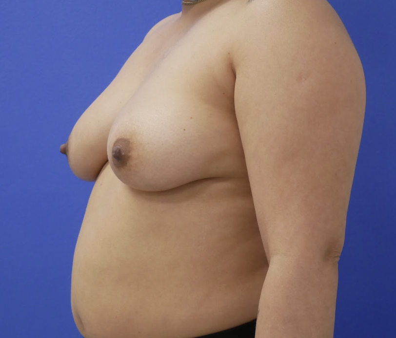 Preop photo of breast