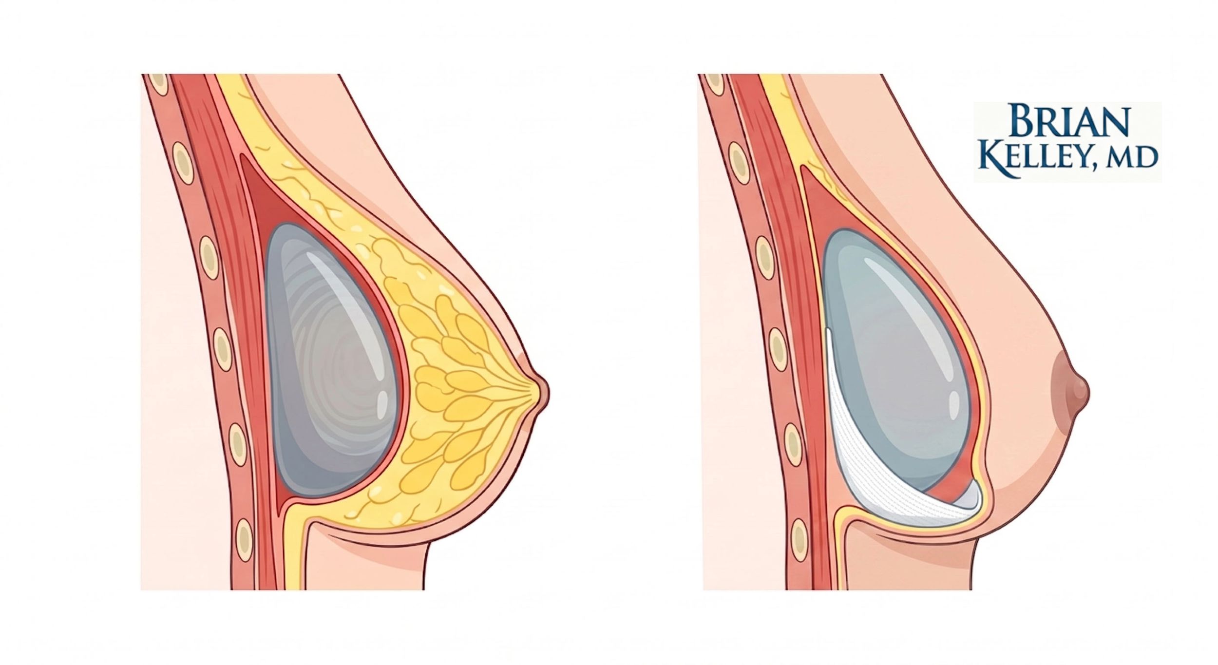 Illustration comparing breast augmentation and post-mastectomy reconstruction implant pockets.
