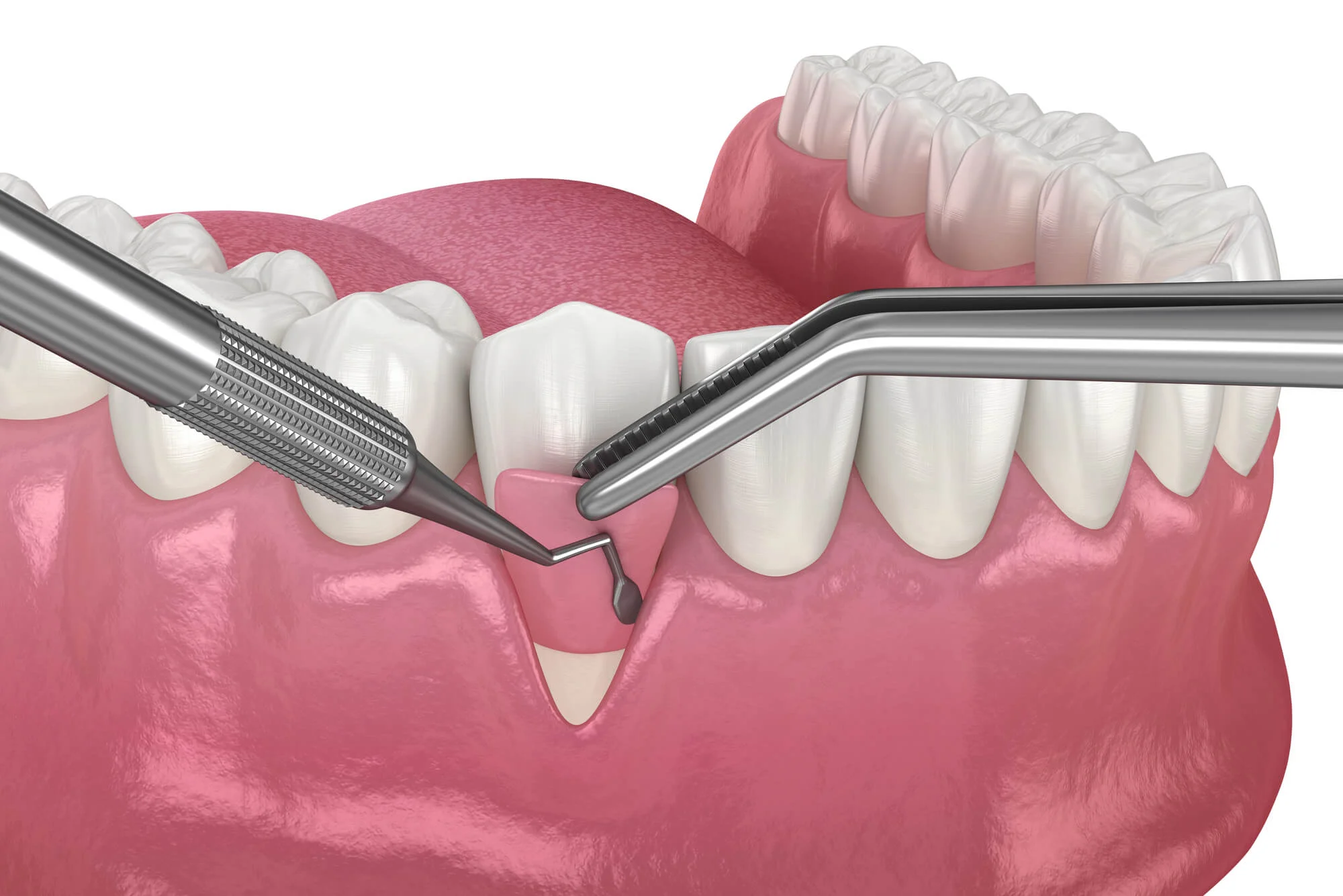 3d illustration of gum procedure