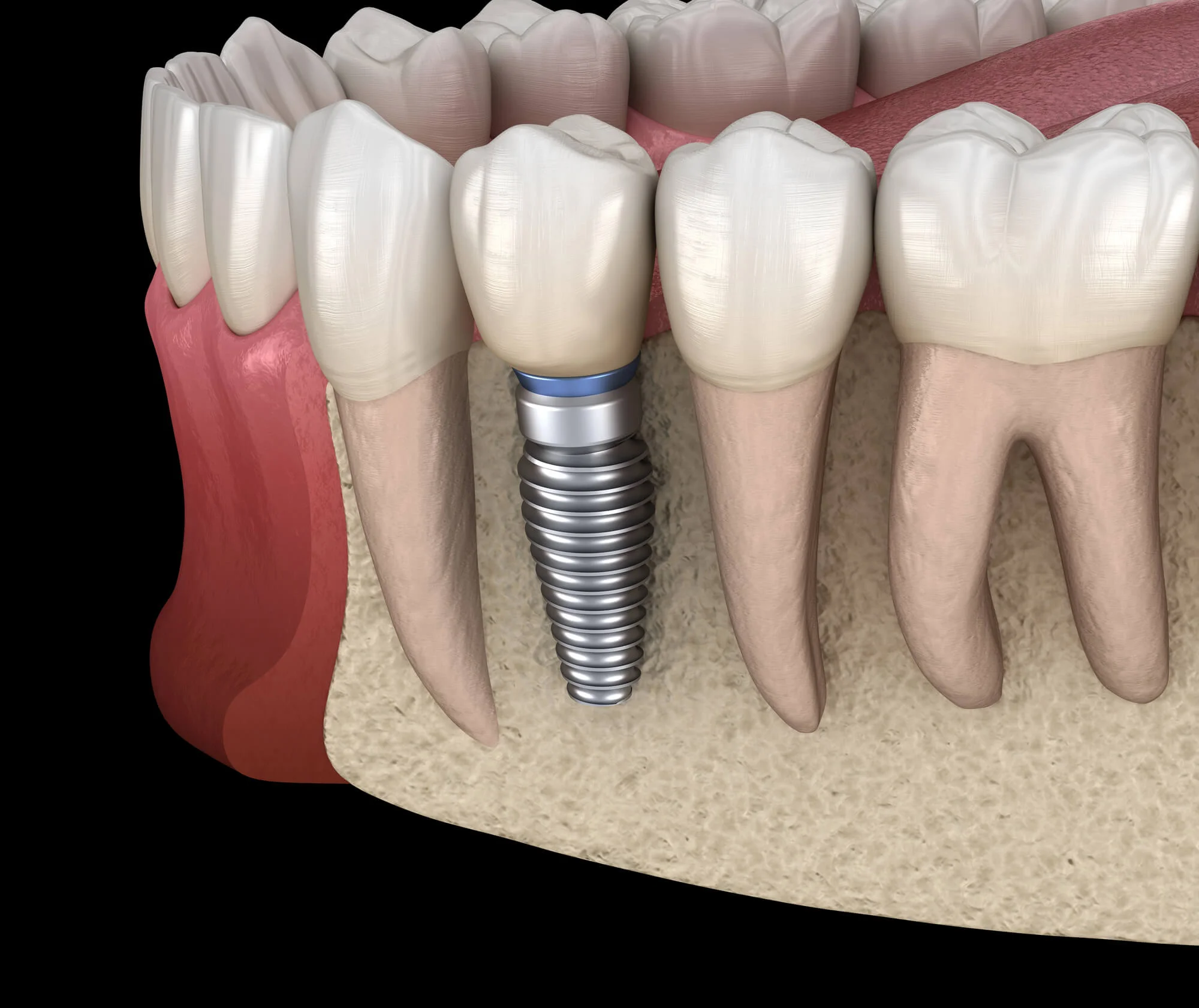 3d illustration of dental implants