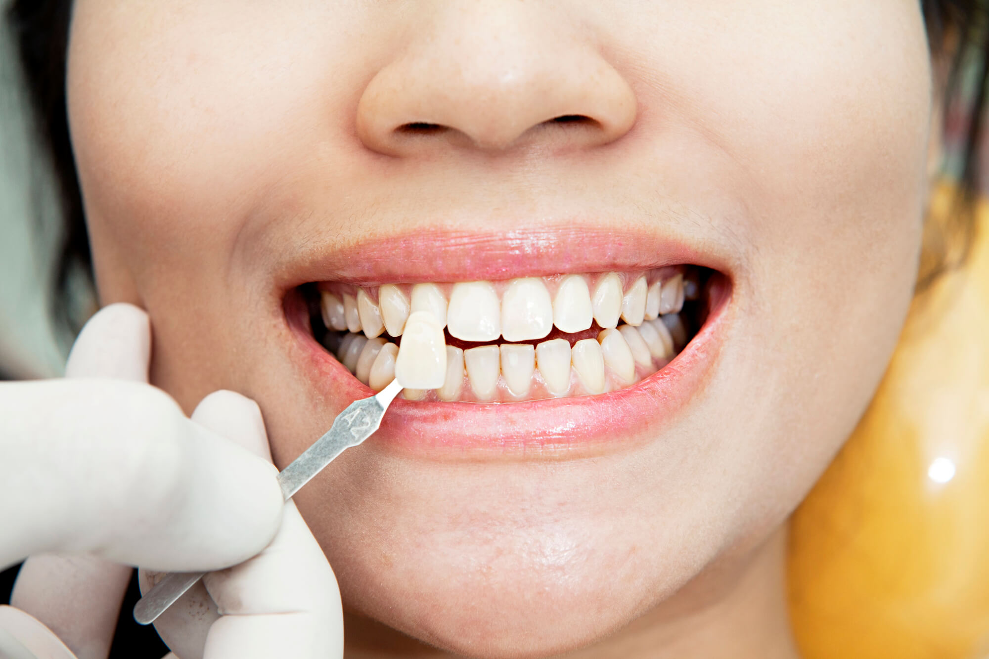 woman choosing shade for her teeth whitening