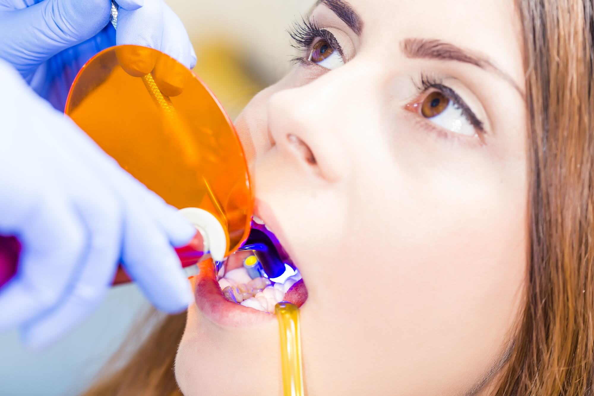 woman getting dental sealants or teeth whitening