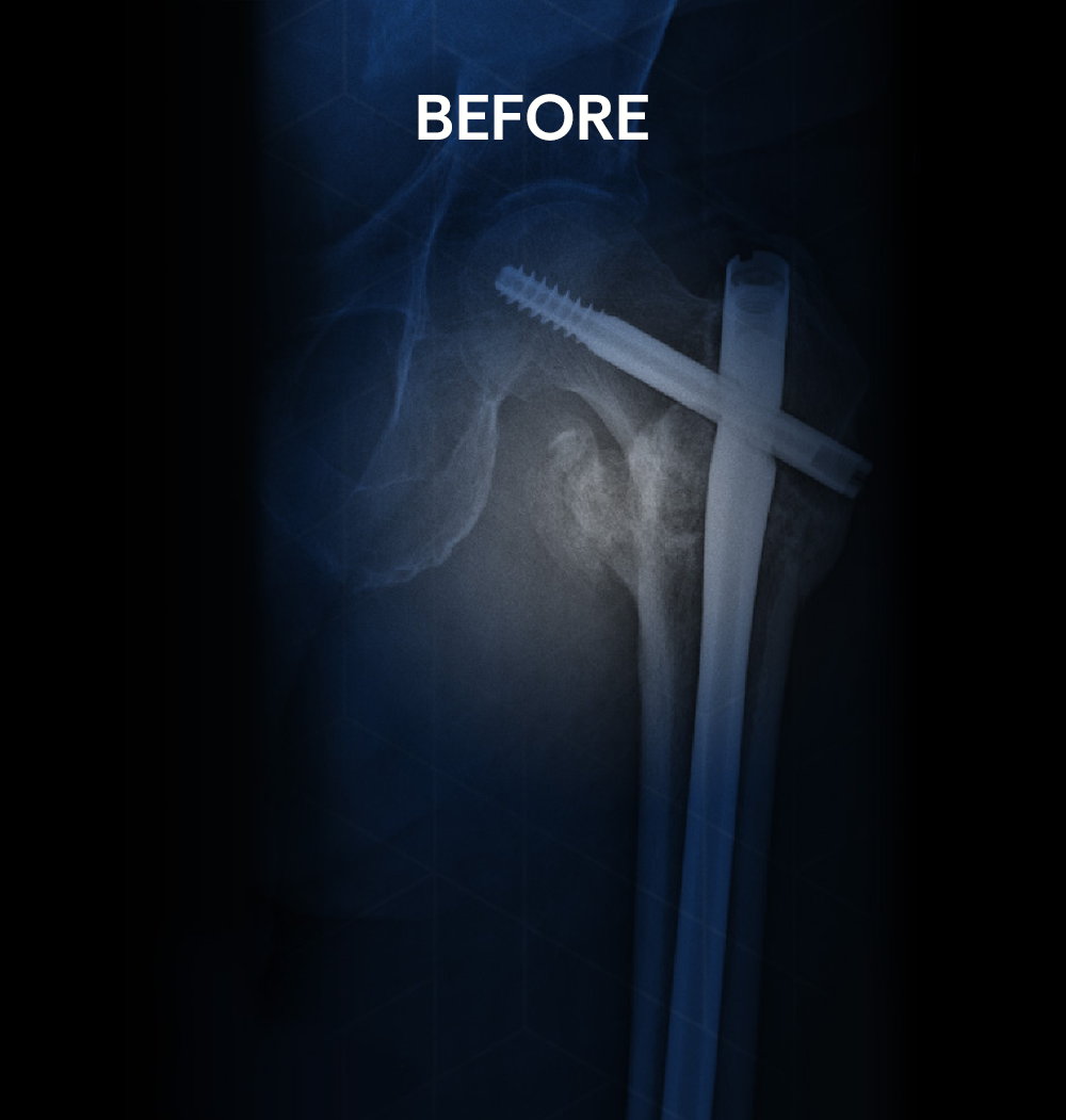 Before X-ray of a left hip fracture showing failed internal fixation hardware, including broken surgical screws and rods, in an 81-year-old male patient treated by Dr. Jeffrey A. Geller MD.