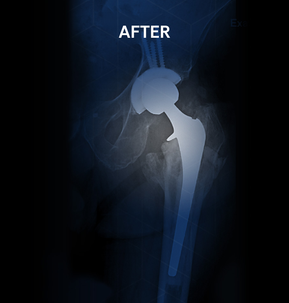 After X-ray of the same left hip following minimally invasive anterior hip replacement surgery by Dr. Jeffrey A. Geller MD, showing a successfully implanted total hip prosthesis replacing the failed hardware.