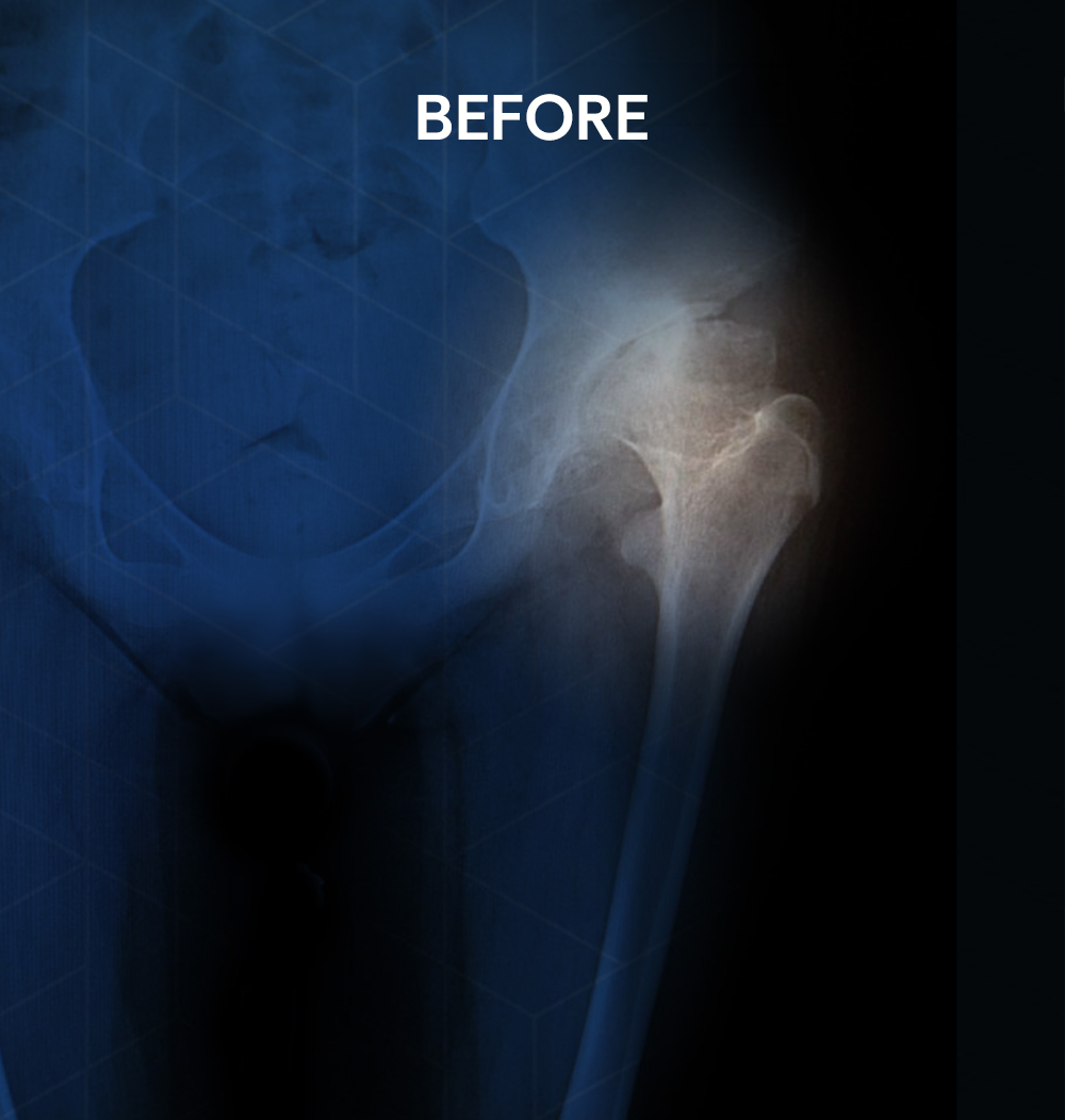 Before X-ray of a 25-year-old female patient's hip showing severe hip dysplasia with significant joint deformity and deterioration prior to anterior hip replacement surgery by Dr. Jeffrey A. Geller MD.