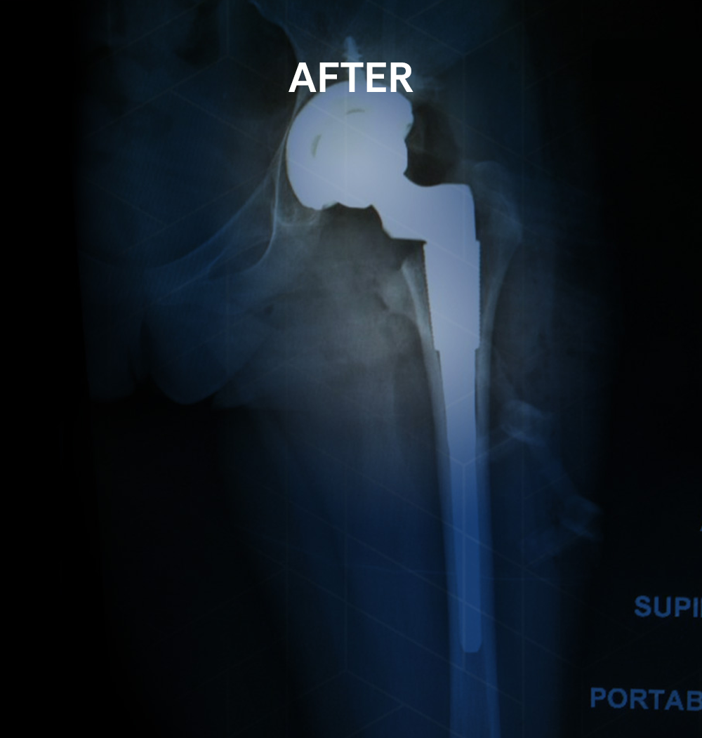 After X-ray of the same hip following minimally invasive anterior hip replacement surgery by Dr. Jeffrey A. Geller MD, showing a correctly positioned total hip prosthesis restoring normal joint alignment.