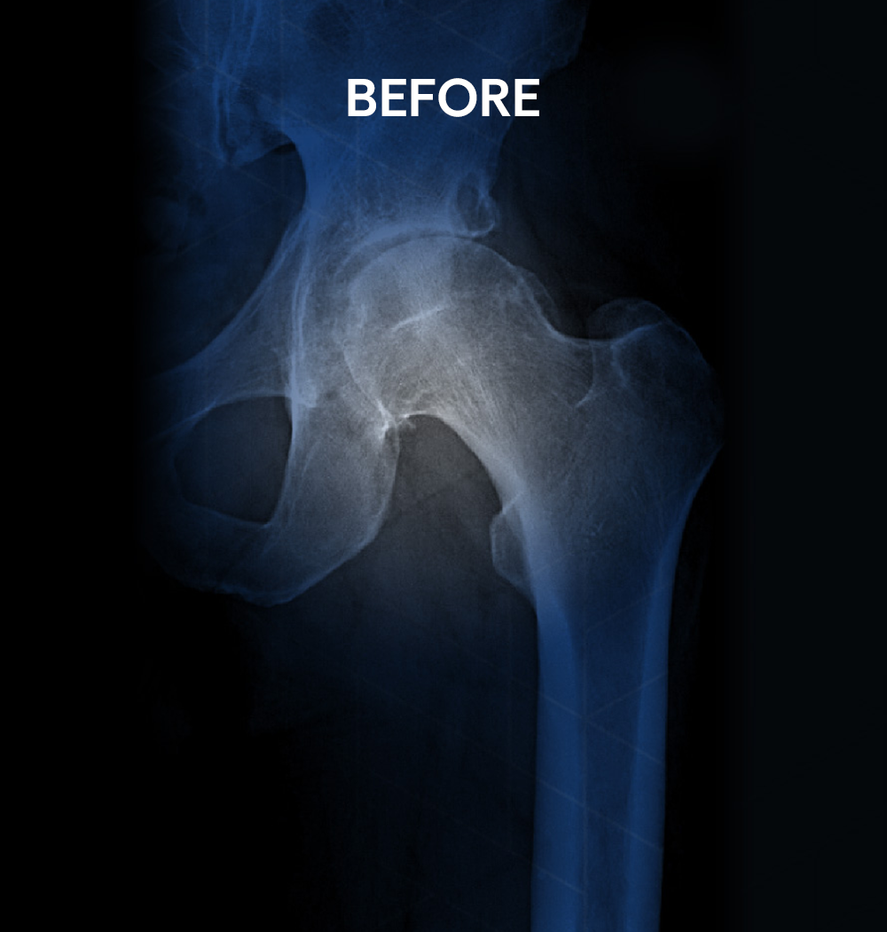Before X-ray of a 49-year-old male patient's hip prior to minimally invasive anterior hip replacement surgery performed by Dr. Jeffrey A. Geller MD.