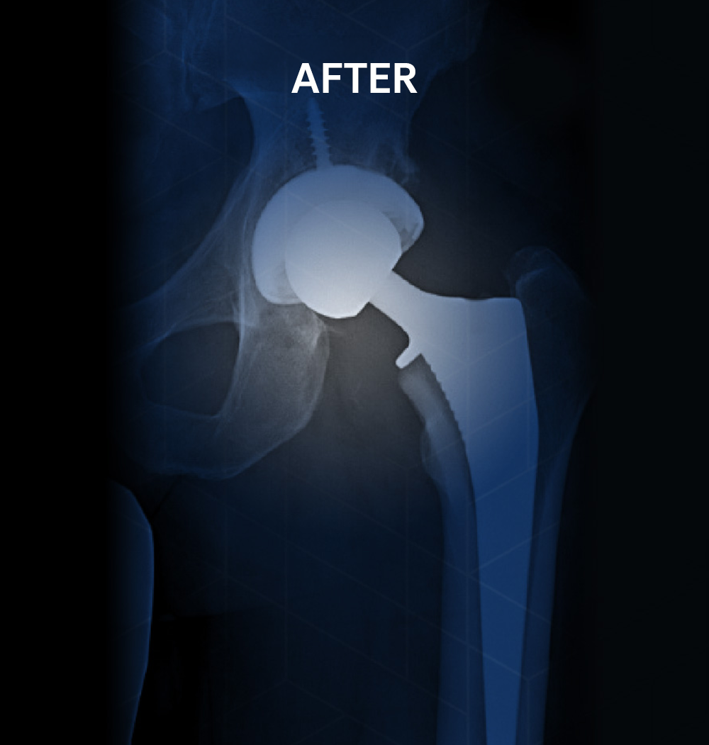 After X-ray of the same hip following same-day minimally invasive anterior hip replacement surgery by Dr. Jeffrey A. Geller MD, showing a successfully implanted hip prosthesis allowing the patient to return to bicycling and running.